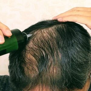 AGA治療成功後の「維持期」戦略：薬の減量とストップの判断基準