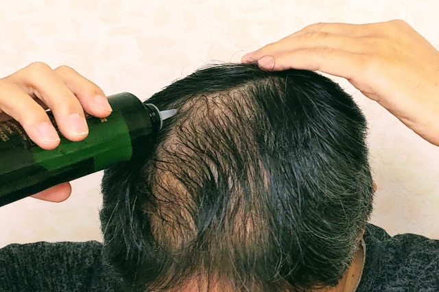 AGA治療薬のジェネリック徹底比較：価格、成分、信頼性