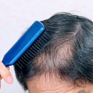 AGA治療成功後の「維持期」戦略：薬の減量とストップの判断基準