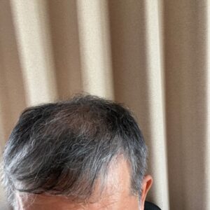 【定年後の安心】薄毛治療を「生涯コスト」で考える！費用を半額にする50代向け戦略