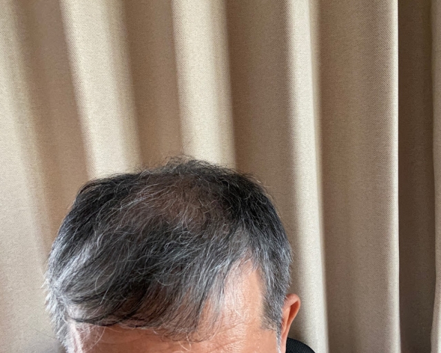 50代必見！体調と仕事を両立できる【AGA治療】クリニック3選