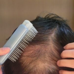 AGA治療成功後の「維持期」戦略：薬の減量とストップの判断基準