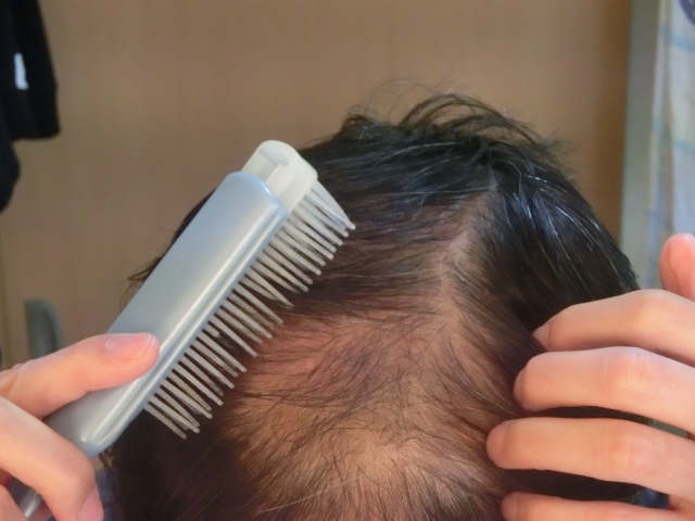 【定年後の安心】薄毛治療を「生涯コスト」で考える！費用を半額にする50代向け戦略