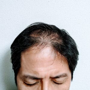 AGA治療成功後の「維持期」戦略：薬の減量とストップの判断基準