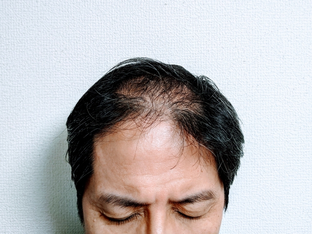 【高血圧とAGA治療薬】降圧剤を飲む50代がミノキシジルで「失敗しない」ための完全ガイド